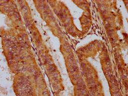 IHC image of CSB-PA722789LA01HU diluted at 1:400 and staining in paraffin-embedded human endometrial cancer performed on a Leica BondTM system. After dewaxing and hydration, antigen retrieval was mediated by high pressure in a citrate buffer (pH 6.0). Section was blocked with 10% normal goat serum 30min at RT. Then primary antibody (1% BSA) was incubated at 4&deg;C overnight. The primary is detected by a biotinylated secondary antibody and visualized using an HRP conjugated SP system.