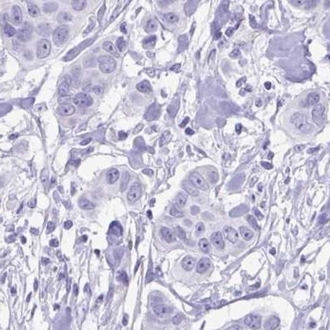 Immunohistochemistry: UBL3 Antibody [NBP2-31730] - breast cancer