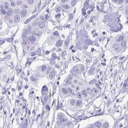 Immunohistochemistry: UBL3 Antibody [NBP2-31730] - breast cancer