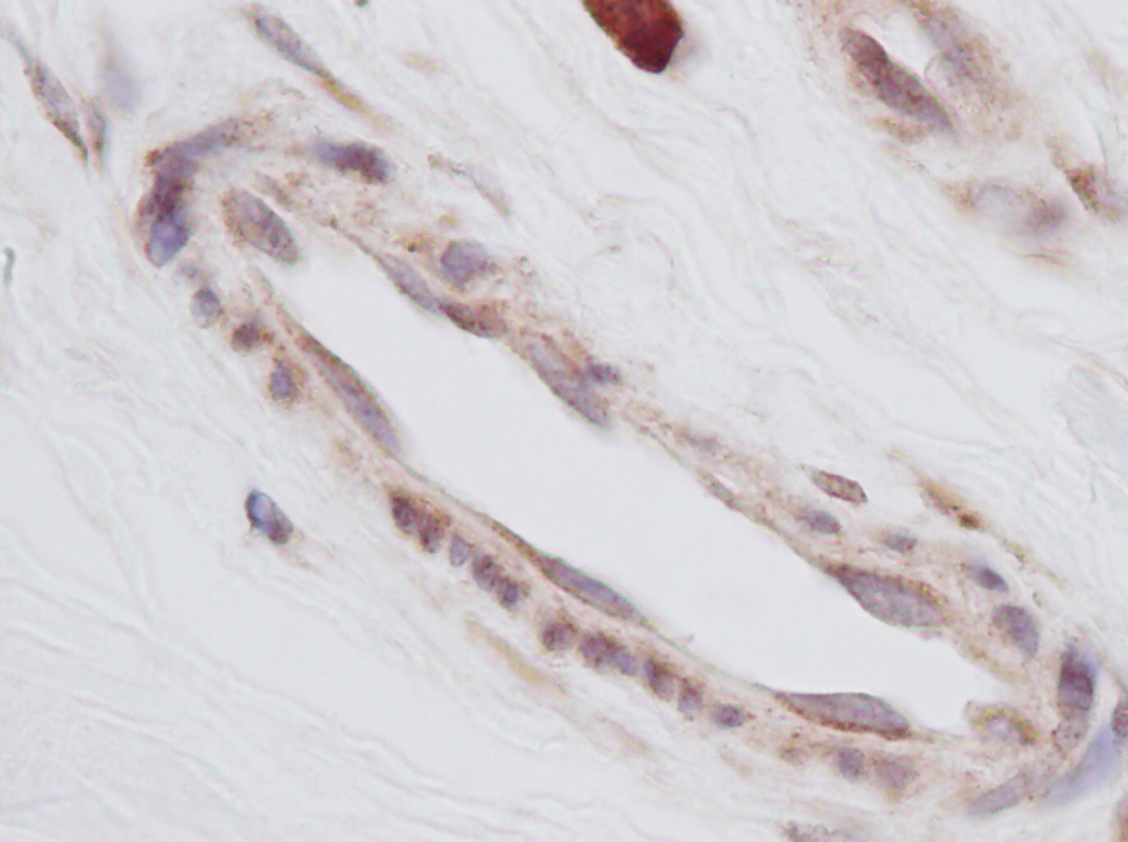 This antibody stained formalin-fixed, paraffin-embedded sections of human breast invasive ductal carcinoma. The recommended concentration is 0.5 ug/ml with a two-hour incubation at room temperature. An HRP-labeled polymer detection system was used with a