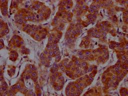 IHC image of CSB-RA240377A0HU diluted at 1:100 and staining in paraffin-embedded human breast cancer performed on a Leica BondTM system. After dewaxing and hydration, antigen retrieval was mediated by high pressure in a citrate buffer (pH 6.0). Section was blocked with 10% normal goat serum 30min at RT. Then primary antibody (1% BSA) was incubated at 4℃ overnight. The primary is detected by a Goat anti-rabbit IgG polymer labeled by HRP and visualized using 0.05% DAB.