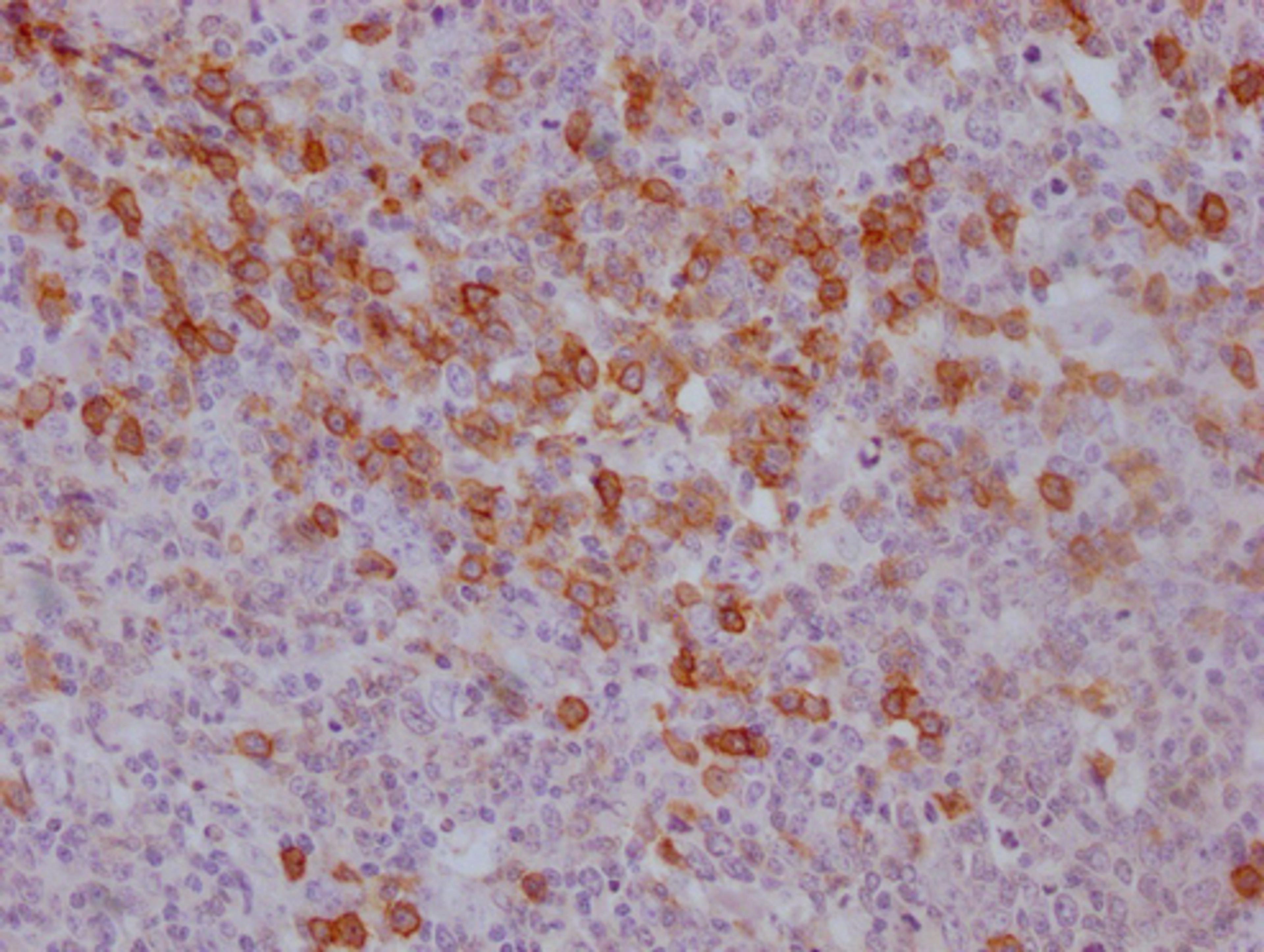 IHC image of CSB-MA785760 diluted at 1:100 and staining in paraffin-embedded human tonsil tissue performed on a Leica BondTM system. After dewaxing and hydration, antigen retrieval was mediated by high pressure in a citrate buffer (pH 6.0). Section was blocked with 10% normal goat serum 30min at RT. Then primary antibody (1% BSA) was incubated at 4°C overnight. The primary is detected by a Goat anti-mouse IgG polymer labeled by HRP and visualized using 0.05% DAB.