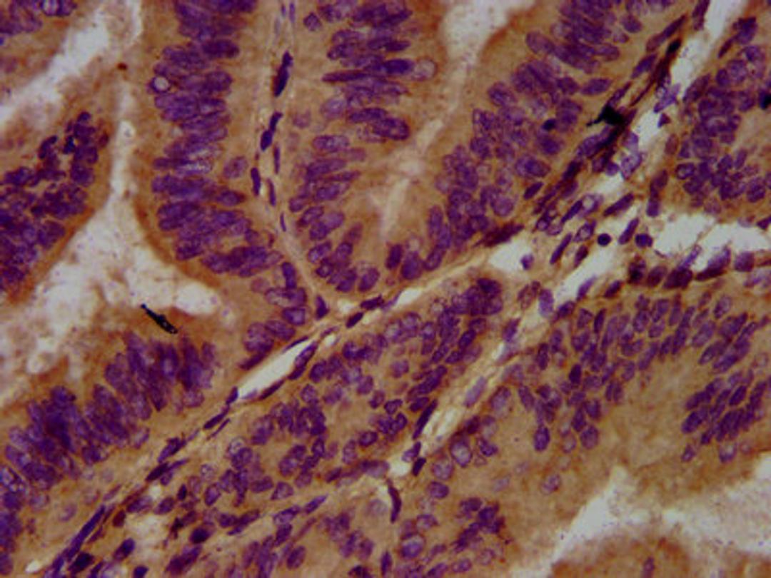 IHC image of CSB-PA812970LA01HU diluted at 1:400 and staining in paraffin-embedded human endometrial cancer performed on a Leica BondTM system. After dewaxing and hydration, antigen retrieval was mediated by high pressure in a citrate buffer (pH 6.0). Section was blocked with 10% normal goat serum 30min at RT. Then primary antibody (1% BSA) was incubated at 4°C overnight. The primary is detected by a biotinylated secondary antibody and visualized using an HRP conjugated SP system.