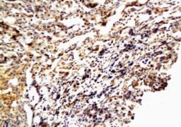 Immunohistochemical staining of paraffin embedded human stomach cancer tissue using MMP2 antibody