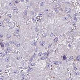 Immunohistochemistry: SFTA3 Antibody [NBP2-32460] - liver cancer