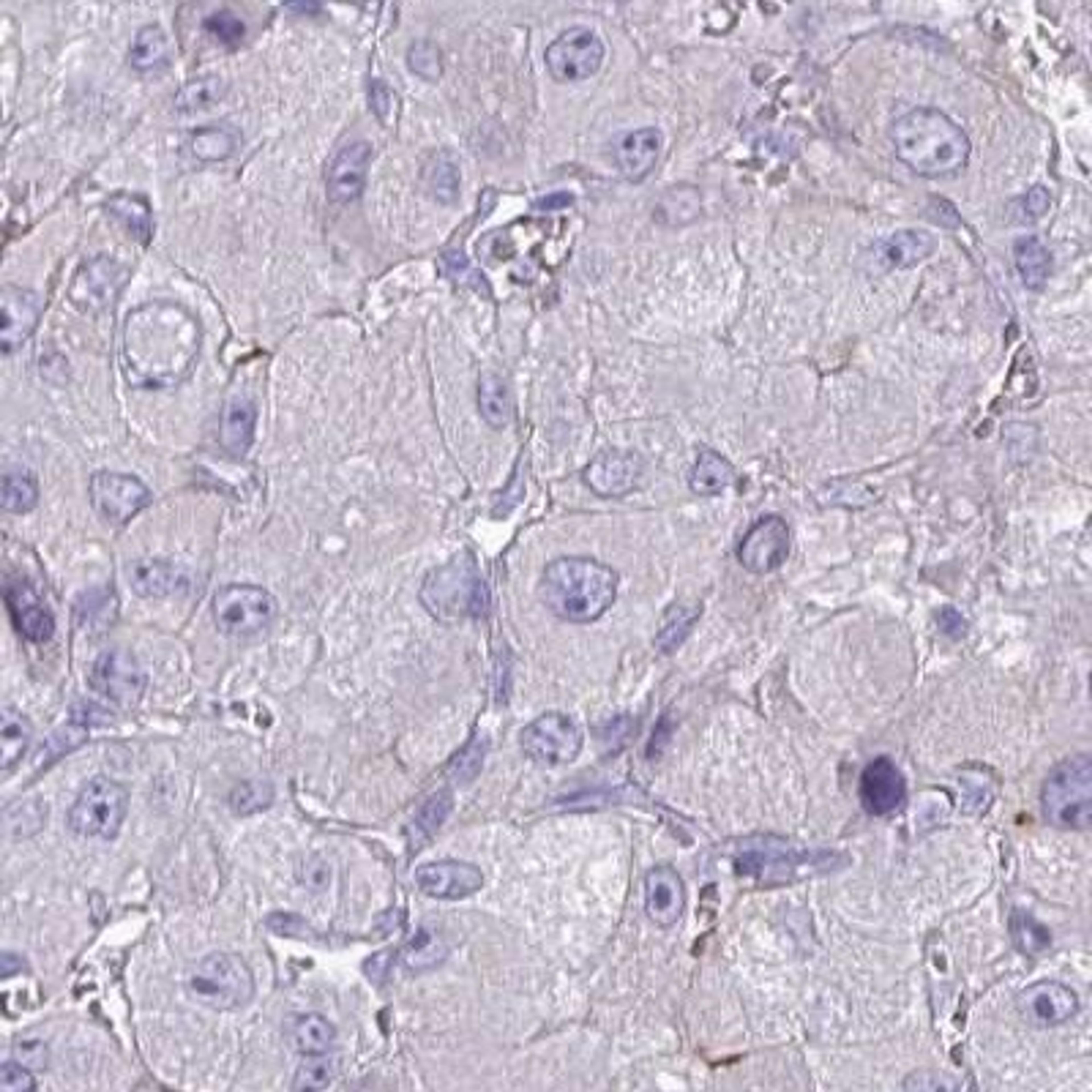 Immunohistochemistry: SFTA3 Antibody [NBP2-32460] - liver cancer