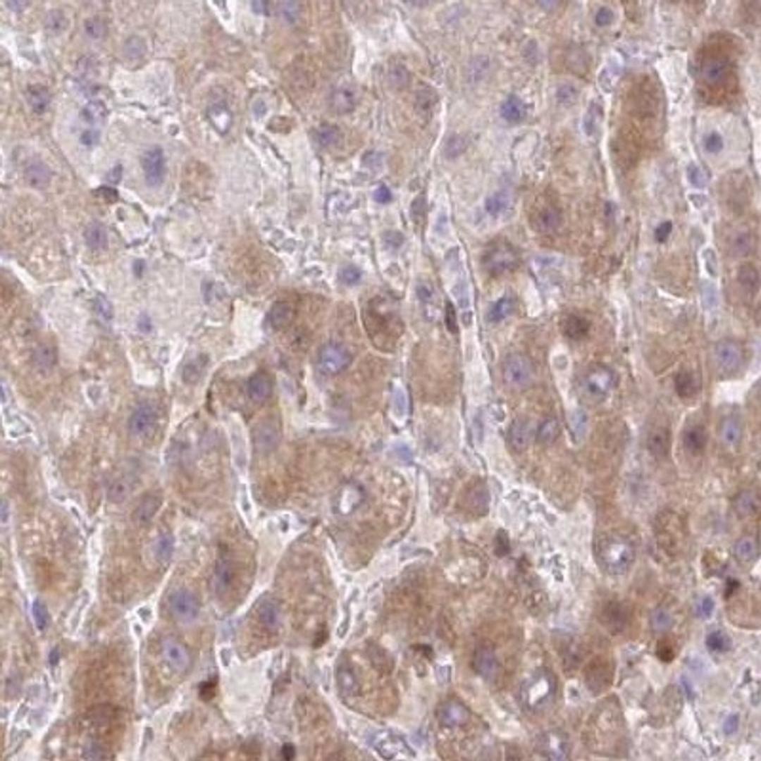 Immunohistochemistry: ZFP41 Antibody [NBP2-31633] - liver cancer