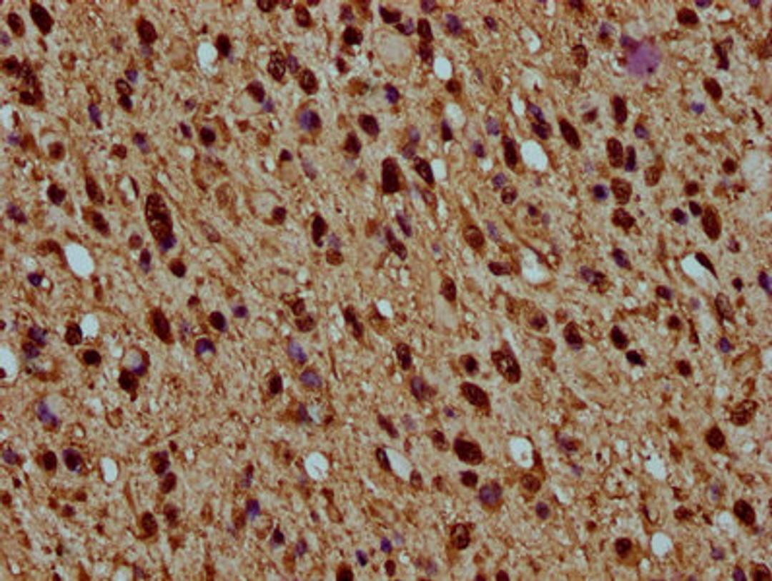 IHC image of CSB-PA010429OA77nhibHU diluted at 1:5 and staining in paraffin-embedded human glioma performed on a Leica BondTM system. After dewaxing and hydration, antigen retrieval was mediated by high pressure in a citrate buffer (pH 6.0). Section was blocked with 10% normal goat serum 30min at RT. Then primary antibody (1% BSA) was incubated at 4°C overnight. The primary is detected by a biotinylated secondary antibody and visualized using an HRP conjugated SP system.
