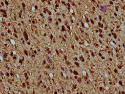 IHC image of CSB-PA010429OA77nhibHU diluted at 1:5 and staining in paraffin-embedded human glioma performed on a Leica BondTM system. After dewaxing and hydration, antigen retrieval was mediated by high pressure in a citrate buffer (pH 6.0). Section was blocked with 10% normal goat serum 30min at RT. Then primary antibody (1% BSA) was incubated at 4°C overnight. The primary is detected by a biotinylated secondary antibody and visualized using an HRP conjugated SP system.