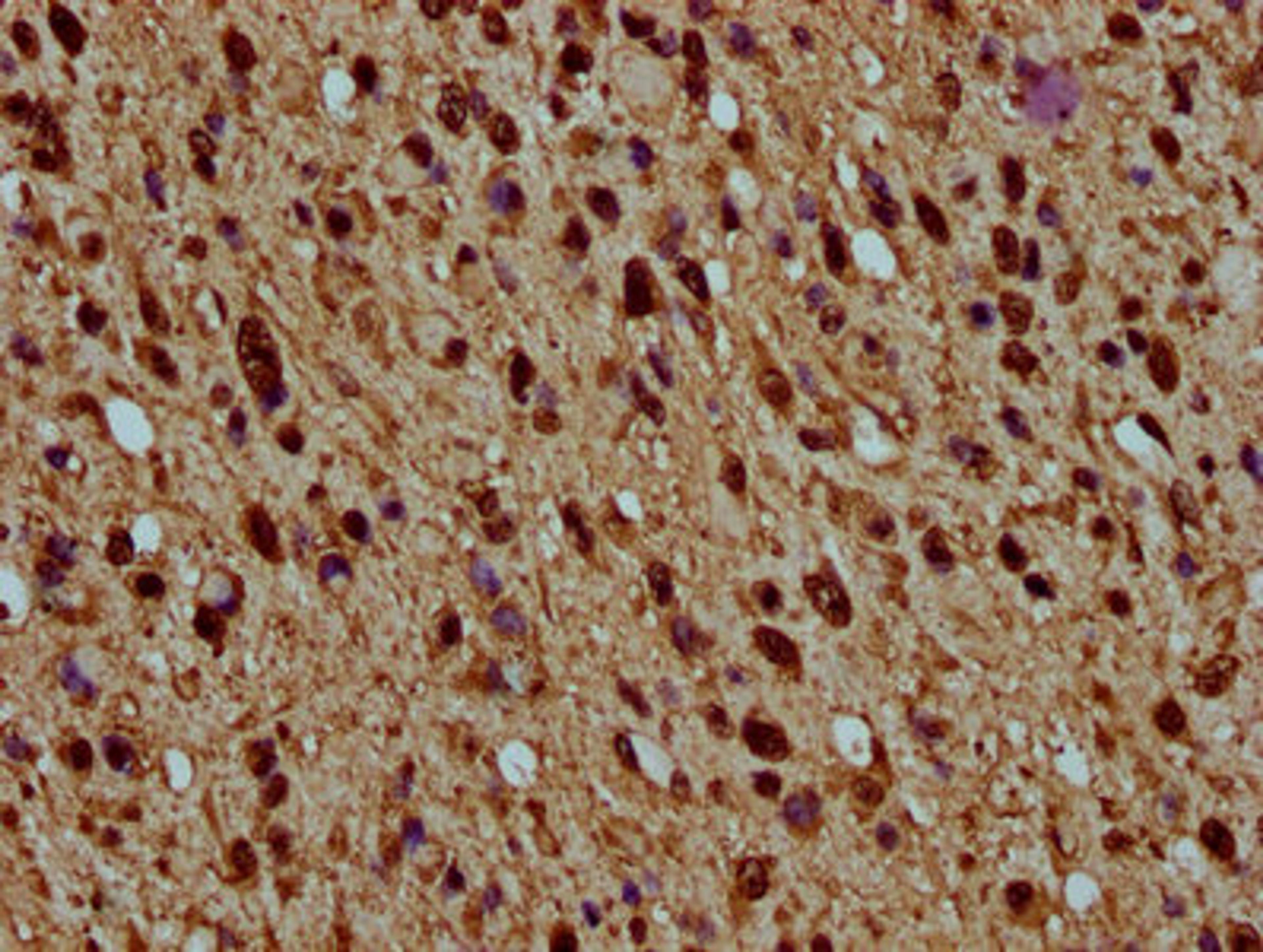 IHC image of CSB-PA010429OA77nhibHU diluted at 1:5 and staining in paraffin-embedded human glioma performed on a Leica BondTM system. After dewaxing and hydration, antigen retrieval was mediated by high pressure in a citrate buffer (pH 6.0). Section was blocked with 10% normal goat serum 30min at RT. Then primary antibody (1% BSA) was incubated at 4°C overnight. The primary is detected by a biotinylated secondary antibody and visualized using an HRP conjugated SP system.