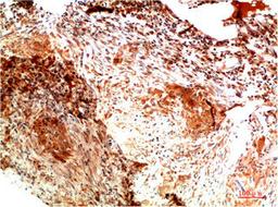 Immunohistochemical analysis of paraffin-embedded Human Lung Carcinoma Tissue using Collagen II  Mouse mAb diluted at 1:200.