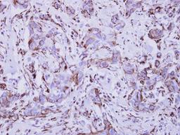 Immunohistochemistry-Paraffin: IFNGR1 Antibody [NBP2-16924] - Immunohistochemical analysis of paraffin-embedded Breast ca, using antibody at 1:250 dilution.