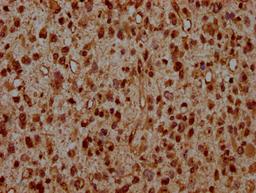 IHC image of CSB-PA010389OA95ncrHU diluted at 1:20 and staining in paraffin-embedded human glioma performed on a Leica BondTM system. After dewaxing and hydration, antigen retrieval was mediated by high pressure in a citrate buffer (pH 6.0). Section was blocked with 10% normal goat serum 30min at RT. Then primary antibody (1% BSA) was incubated at 4&deg;C overnight. The primary is detected by a biotinylated secondary antibody and visualized using an HRP conjugated SP system.