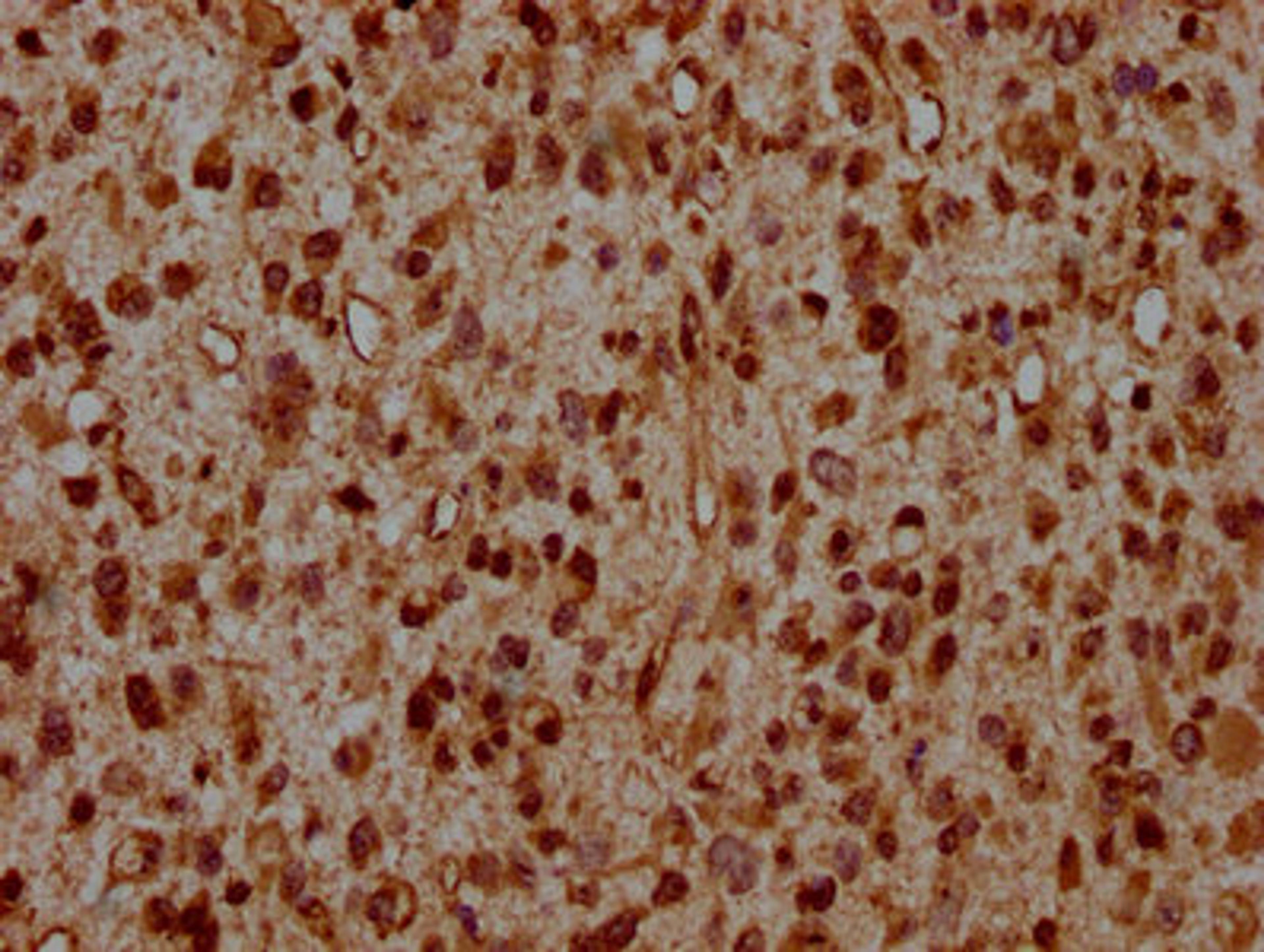 IHC image of CSB-PA010389OA95ncrHU diluted at 1:20 and staining in paraffin-embedded human glioma performed on a Leica BondTM system. After dewaxing and hydration, antigen retrieval was mediated by high pressure in a citrate buffer (pH 6.0). Section was blocked with 10% normal goat serum 30min at RT. Then primary antibody (1% BSA) was incubated at 4&deg;C overnight. The primary is detected by a biotinylated secondary antibody and visualized using an HRP conjugated SP system.