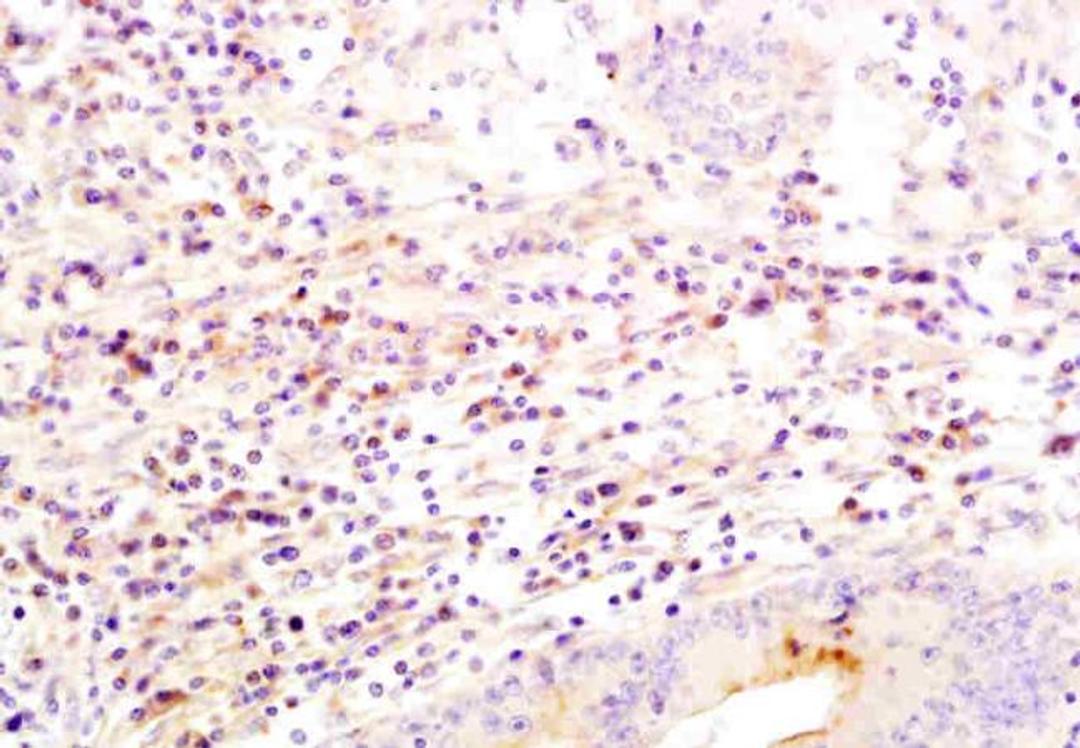 IHC-P of human colorectal cancer using SLC26A4 antibody.