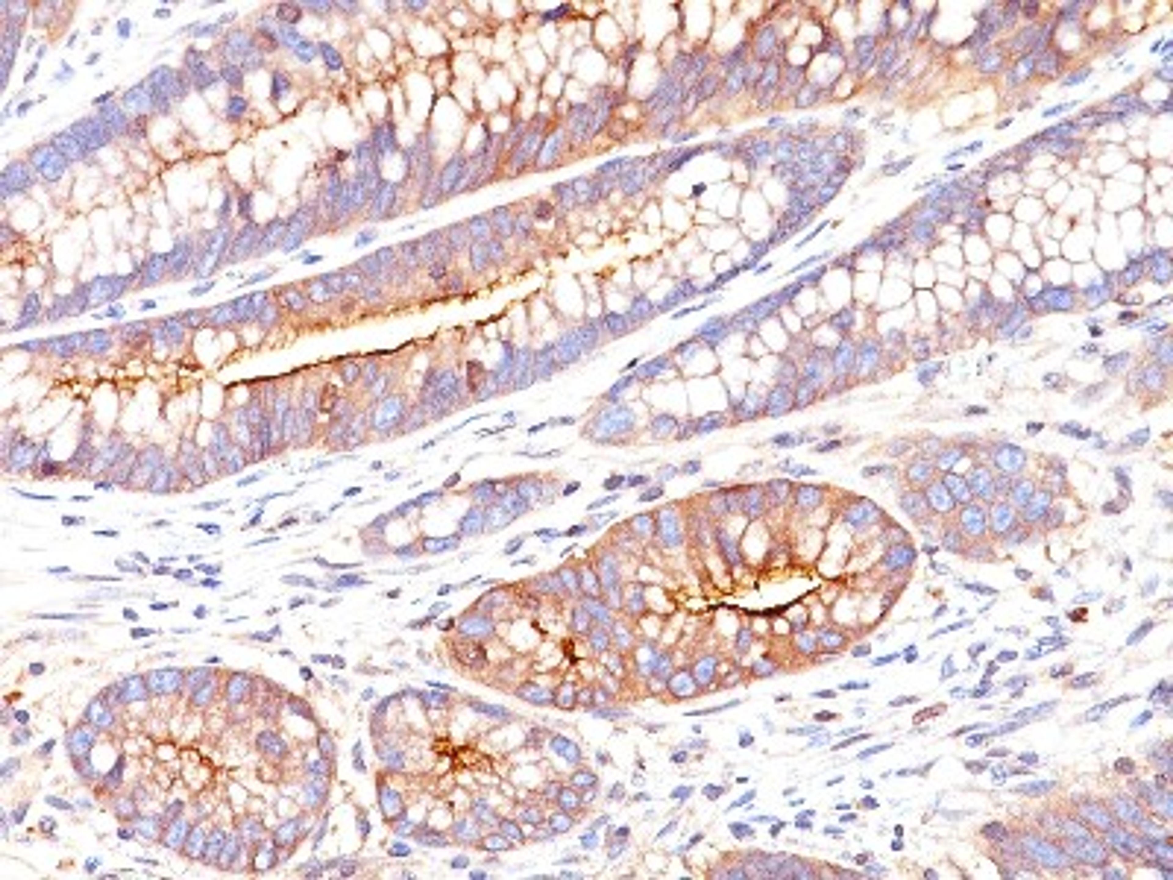 Immunohistochemistry-Paraffin: CEA Antibody (SPM551) [NBP2-33011] - Formalin-paraffin colon stained with CEA MAb (SPM551)