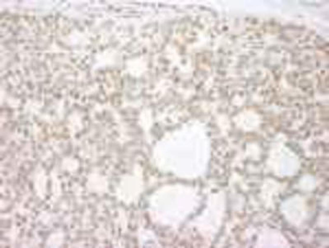 Immunohistochemistry-Paraffin: p73 Antibody [NB100-420] - FFPE section of human basal cell carcinoma.  Affinity purified rabbit anti-p73 used at a dilution of 1:250.