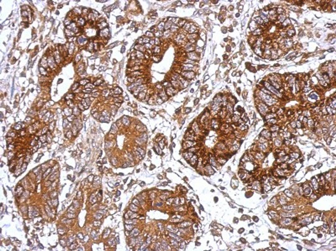 Immunohistochemistry-Paraffin: G protein alpha Antibody [NBP1-31730] - Paraffin-embedded Colon ca, using antibody at 1:500 dilution.