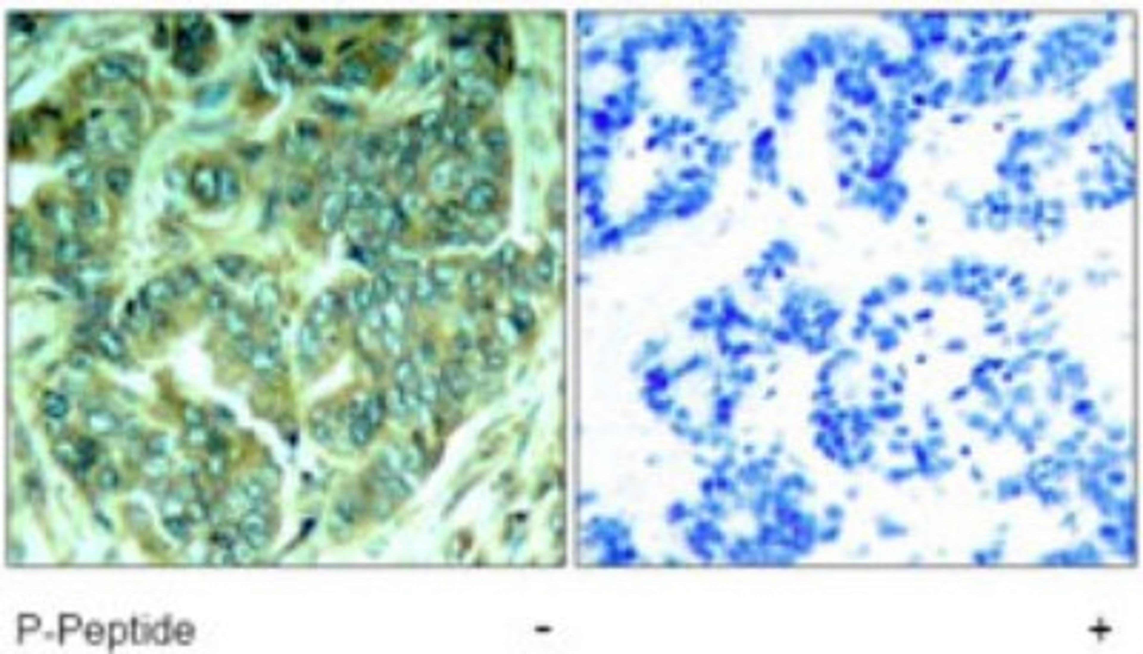 Immunohistochemistry-Paraffin: DOK1 [p Tyr398] Antibody [NB100-82113] - Immunohistochemical analysis of DOK1 (Tyr398) in paraffin-embedded human breast carcinoma tissue using NB100-82113.