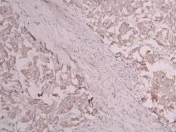 IHC image of CSB-RA801238MA1HU diluted at 1:300 and staining in paraffin-embedded human breast cancer performed on a Leica BondTM system. After dewaxing and hydration, antigen retrieval was mediated by high pressure in a citrate buffer (pH 6.0). Section was blocked with 10% normal goat serum 30min at RT. Then primary antibody (1% BSA) was incubated at 4°C overnight. The primary is detected by a Goat anti-human polymer IgG labeled by HRP and visualized using 0.05% DAB.