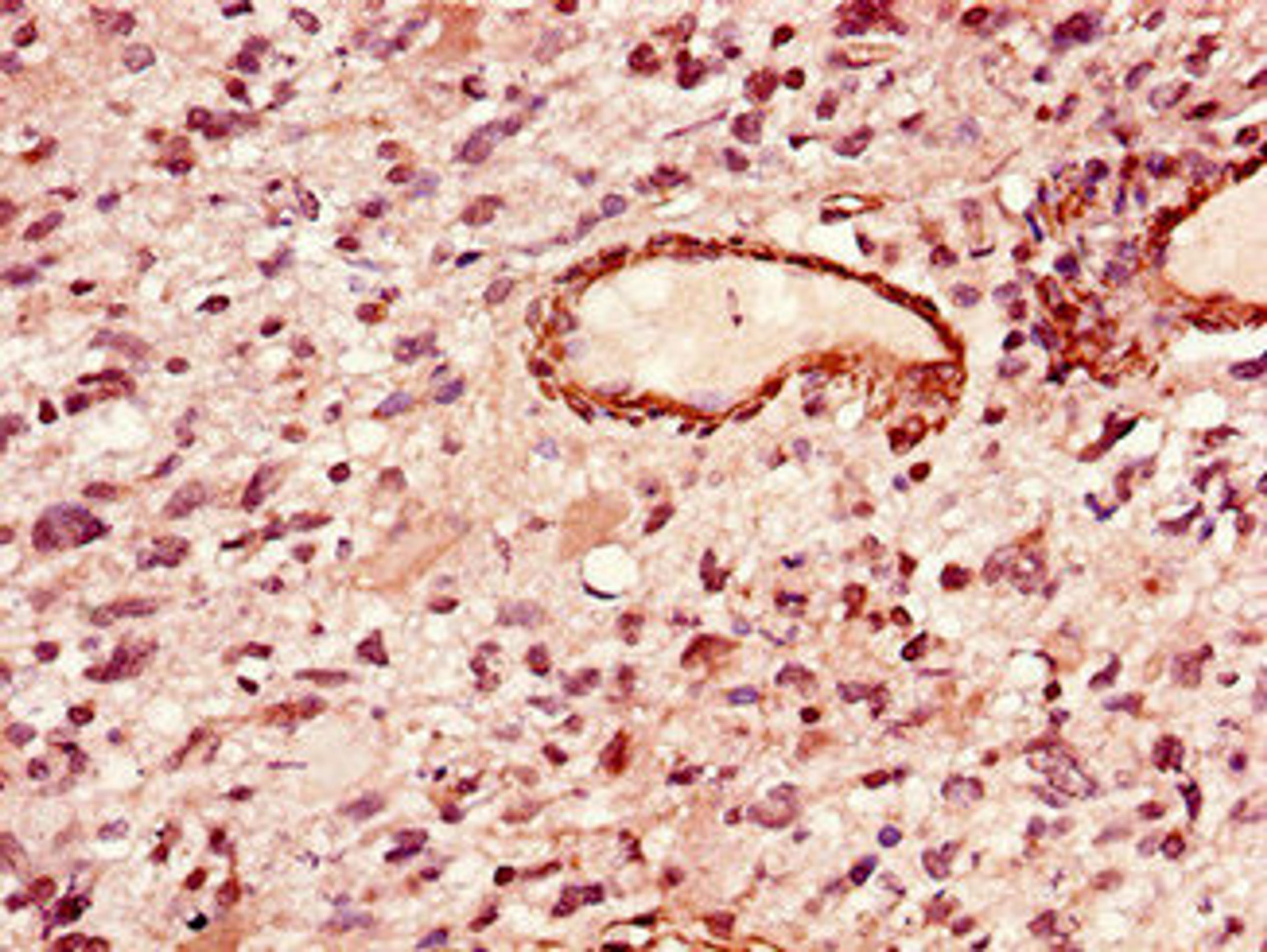 Immunohistochemistry of paraffin-embedded human glioma using CSB-PA012975LA01HU at dilution of 1:100