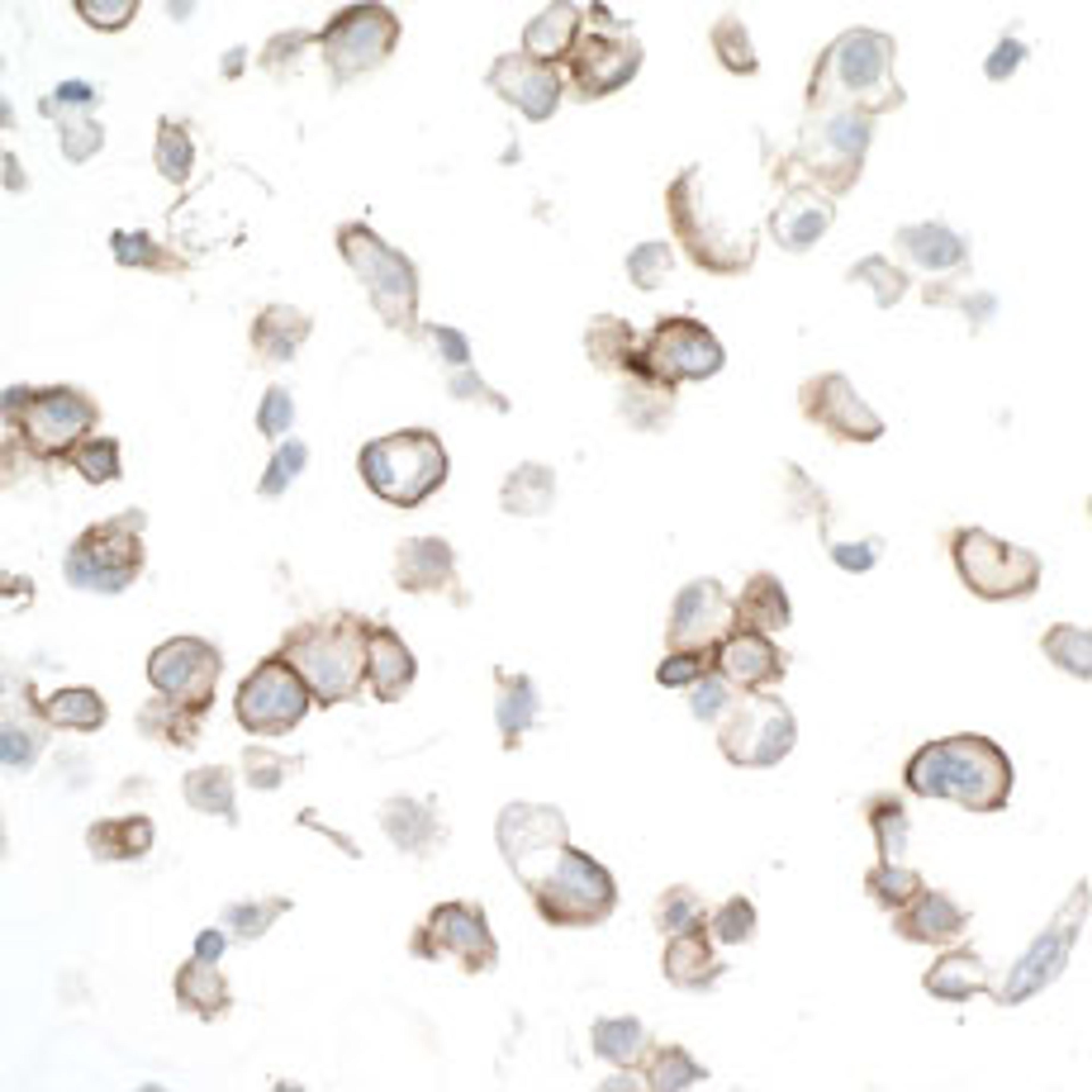 Detection of human CD133 in FFPE OVCAR-4 cells by ICC.