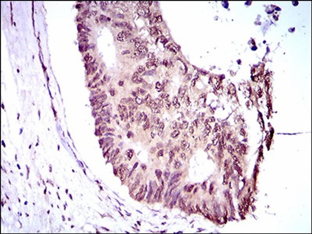 Immunohistochemistry: KLF1 Antibody (1B6A3) [NBP2-37380] - Immunohistochemical analysis of paraffin-embedded rectum cancer tissues using KLF1 mouse mAb with DAB staining.