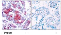 Immunohistochemistry: STAT4 [p Tyr693] Antibody [NB100-82215] - Staining of human breast carcinoma tissue using STAT4 (phospho-Tyr693) antibody