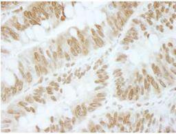 Immunohistochemistry-Paraffin: ZBTB40 Antibody [NBP1-06564] - FFPE section of human colon carcinoma.  Affinity purified rabbit anti-ZBTB40 used at a dilution of 1:500. Detection: DAB staining using Immunohistochemistry Accessory Kit