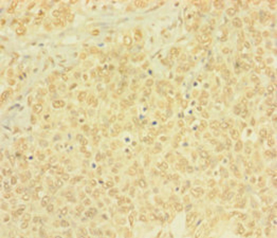Immunohistochemistry of paraffin-embedded human ovarian cancer using CSB-PA878918LA01HU at dilution of 1: 100