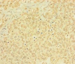Immunohistochemistry of paraffin-embedded human ovarian cancer using CSB-PA878918LA01HU at dilution of 1: 100