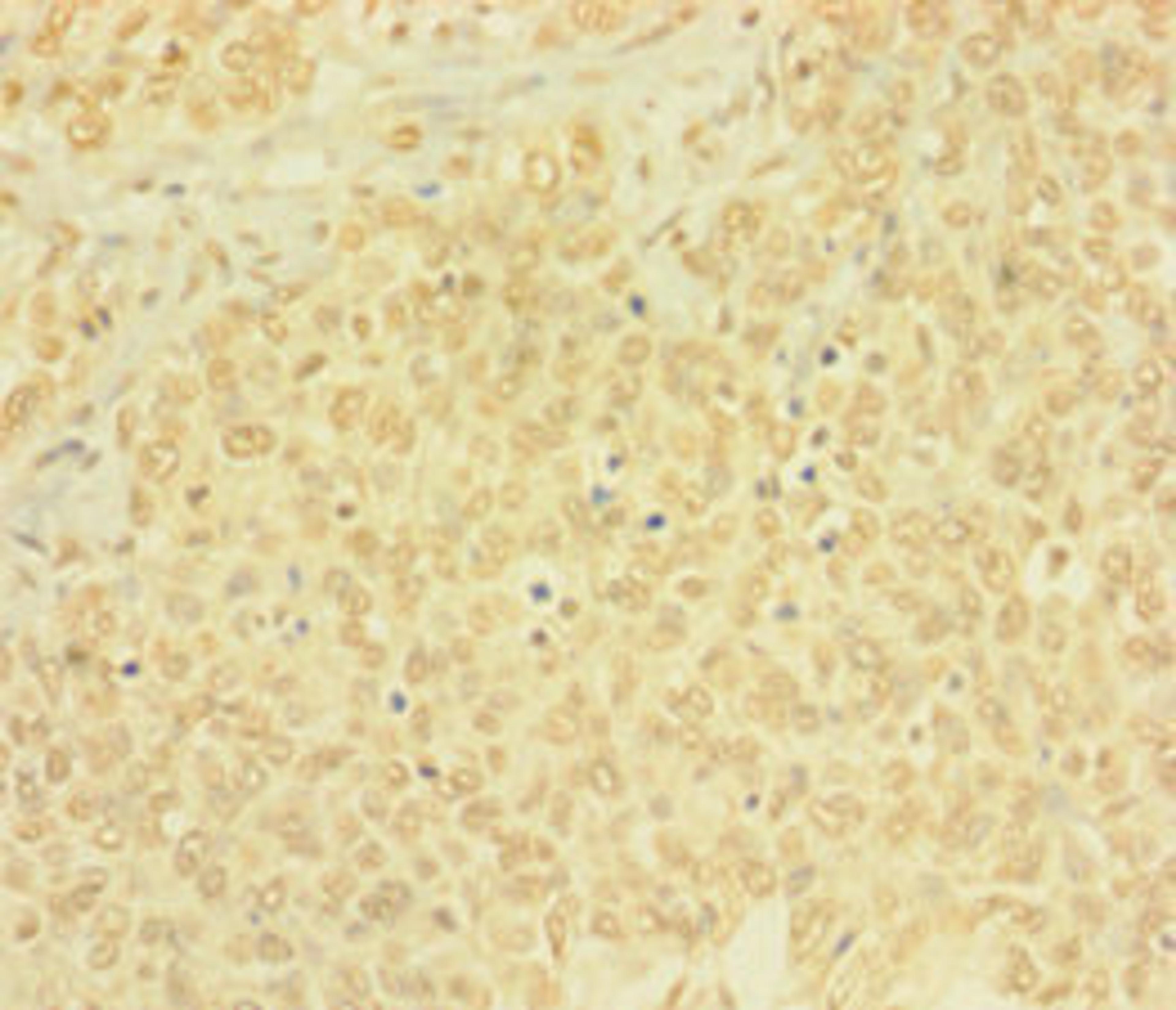 Immunohistochemistry of paraffin-embedded human ovarian cancer using CSB-PA878918LA01HU at dilution of 1: 100