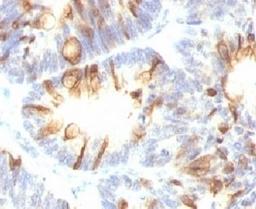 Formalin-fixed, paraffin-embedded human colon carcinoma stained with MUC2 antibody (MLP/842).