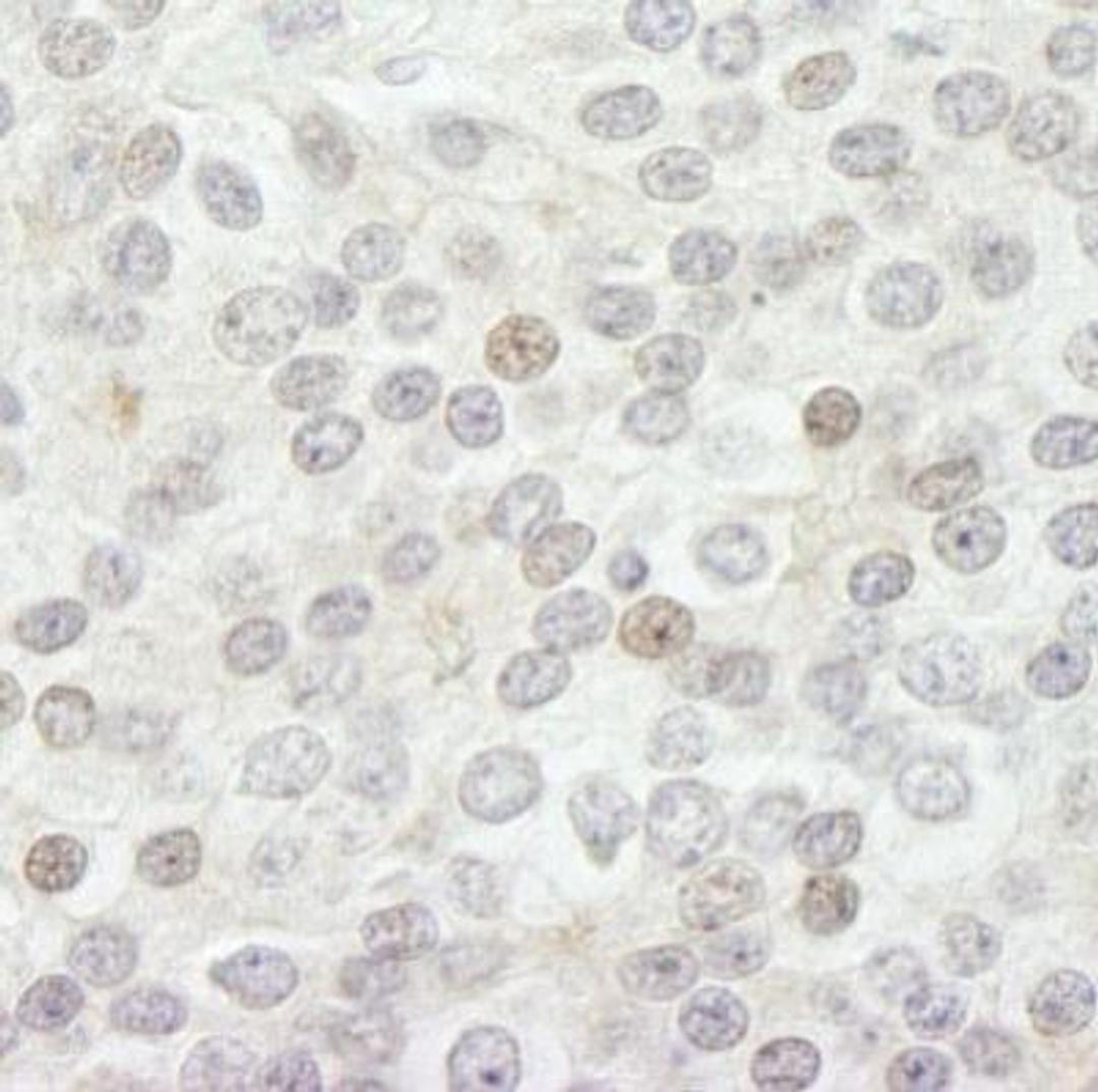 Immunohistochemistry-Paraffin: Lysine (K)-specific Demethylase 5B/KDM5B/JARID1B Antibody [NB100-97821] - Section of human prostate carcinoma.