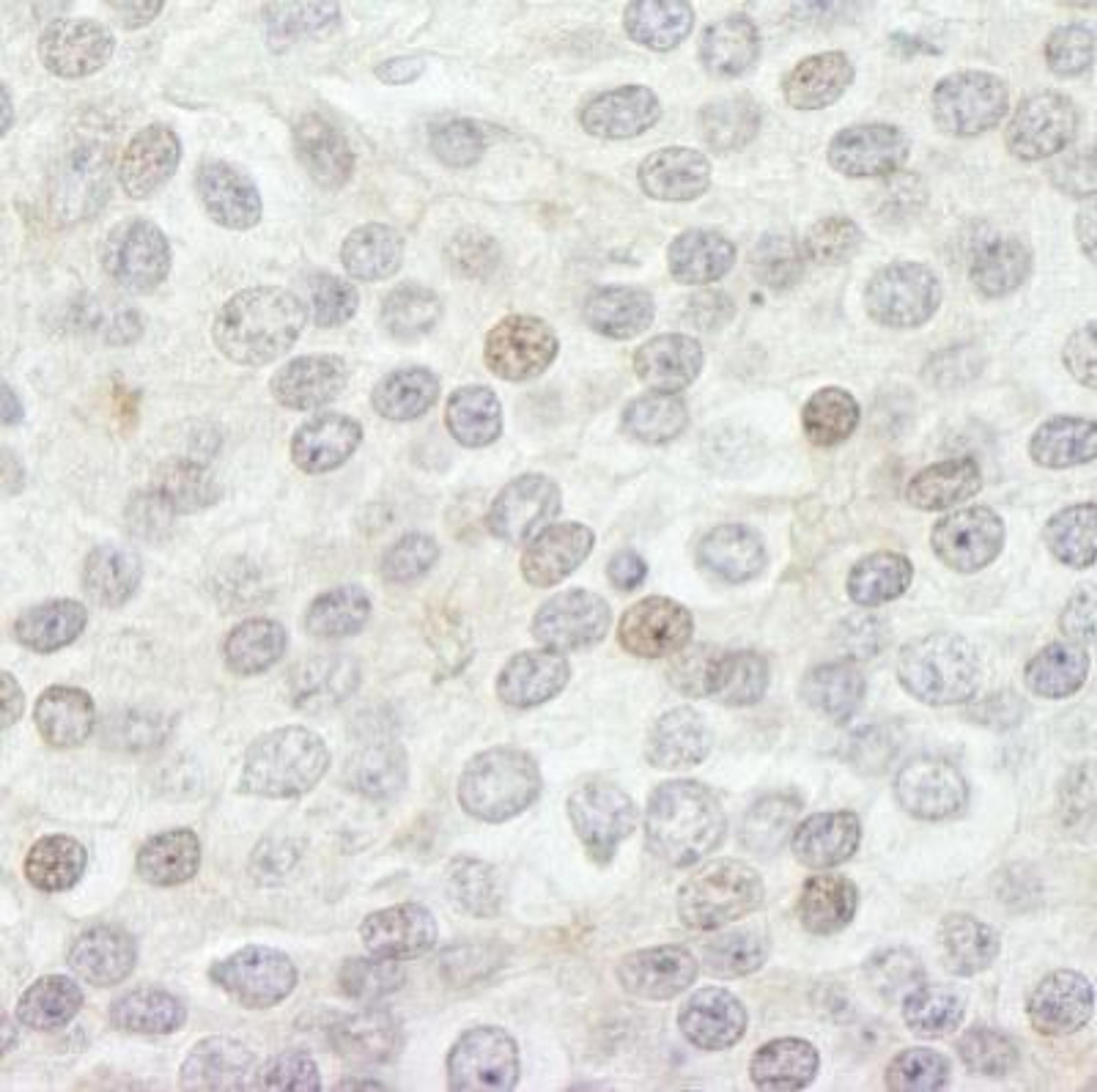 Immunohistochemistry-Paraffin: Lysine (K)-specific Demethylase 5B/KDM5B/JARID1B Antibody [NB100-97821] - Section of human prostate carcinoma.