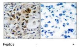 Immunohistochemistry: FOXO4 Antibody [NB100-81773] - Immunohistochemical analysis of paraffin-embedded human lung carcinoma tissue, using AFX (Ab-197) antibody.