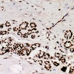 Immunohistochemical staining of human breast cancer tissue using SRSF9 antibody