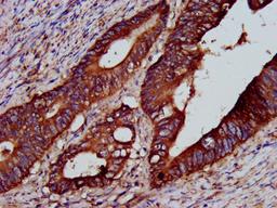 IHC image of CSB-PA613277LA01HU diluted at 1:200 and staining in paraffin-embedded human colon cancer performed on a Leica BondTM system. After dewaxing and hydration, antigen retrieval was mediated by high pressure in a citrate buffer (pH 6.0). Section was blocked with 10% normal goat serum 30min at RT. Then primary antibody (1% BSA) was incubated at 4&deg;C overnight. The primary is detected by a biotinylated secondary antibody and visualized using an HRP conjugated SP system.