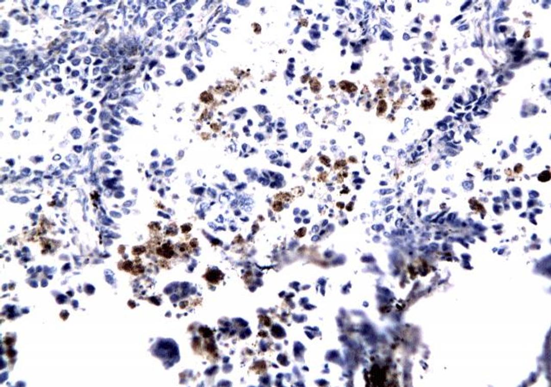 Immunohistochemical analysis of formalin-fixed paraffin embedded human lung cancer tissue using pan Ras antibody