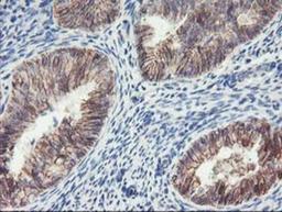 Immunohistochemistry-Paraffin: 15 Lipoxygenase 1 Antibody (3G8) [NBP2-01740] - Staining of paraffin-embedded Adenocarcinoma of Human endometrium tissue using anti-15 Lipoxygenase 1 mouse monoclonal antibody.