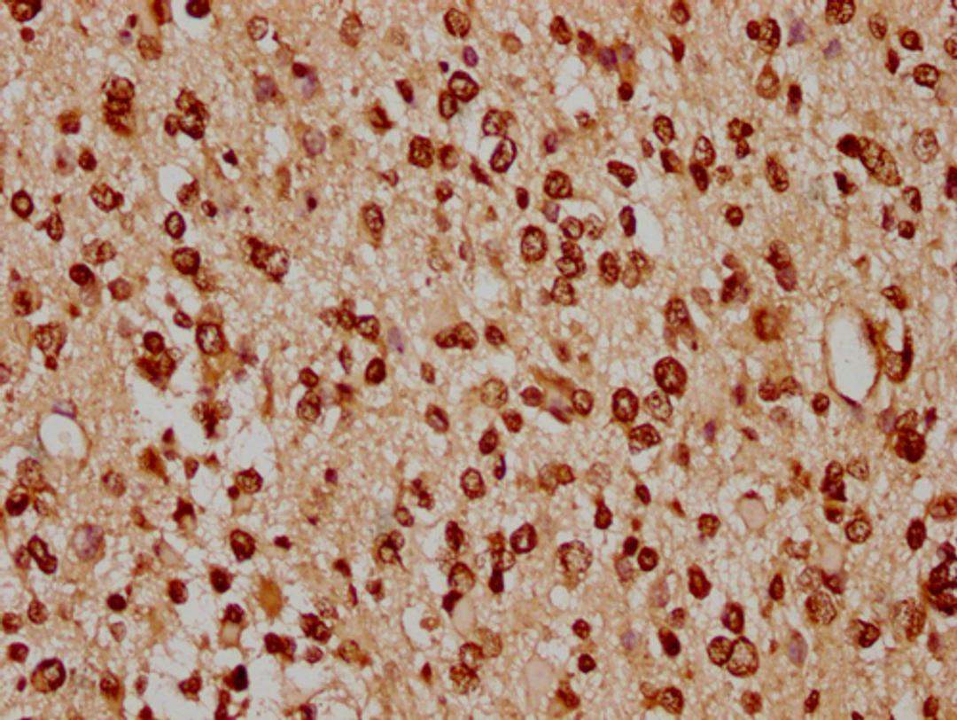 IHC image of CSB-PA010429PA91nacHU diluted at 1:20 and staining in paraffin-embedded human glioma cancer performed on a Leica BondTM system. After dewaxing and hydration, antigen retrieval was mediated by high pressure in a citrate buffer (pH 6.0). Section was blocked with 10% normal goat serum 30min at RT. Then primary antibody (1% BSA) was incubated at 4°C overnight. The primary is detected by a biotinylated secondary antibody and visualized using an HRP conjugated SP system.