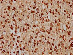 IHC image of CSB-PA010429PA91nacHU diluted at 1:20 and staining in paraffin-embedded human glioma cancer performed on a Leica BondTM system. After dewaxing and hydration, antigen retrieval was mediated by high pressure in a citrate buffer (pH 6.0). Section was blocked with 10% normal goat serum 30min at RT. Then primary antibody (1% BSA) was incubated at 4°C overnight. The primary is detected by a biotinylated secondary antibody and visualized using an HRP conjugated SP system.