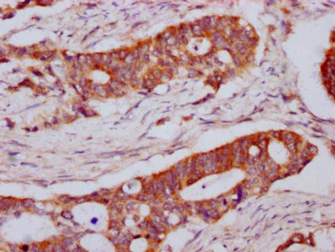 IHC image of CSB-PA013065LA01HU diluted at 1:800 and staining in paraffin-embedded human colon cancer performed on a Leica BondTM system. After dewaxing and hydration, antigen retrieval was mediated by high pressure in a citrate buffer (pH 6.0). Section was blocked with 10% normal goat serum 30min at RT. Then primary antibody (1% BSA) was incubated at 4°C overnight. The primary is detected by a biotinylated secondary antibody and visualized using an HRP conjugated SP system.