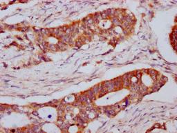 IHC image of CSB-PA013065LA01HU diluted at 1:800 and staining in paraffin-embedded human colon cancer performed on a Leica BondTM system. After dewaxing and hydration, antigen retrieval was mediated by high pressure in a citrate buffer (pH 6.0). Section was blocked with 10% normal goat serum 30min at RT. Then primary antibody (1% BSA) was incubated at 4°C overnight. The primary is detected by a biotinylated secondary antibody and visualized using an HRP conjugated SP system.