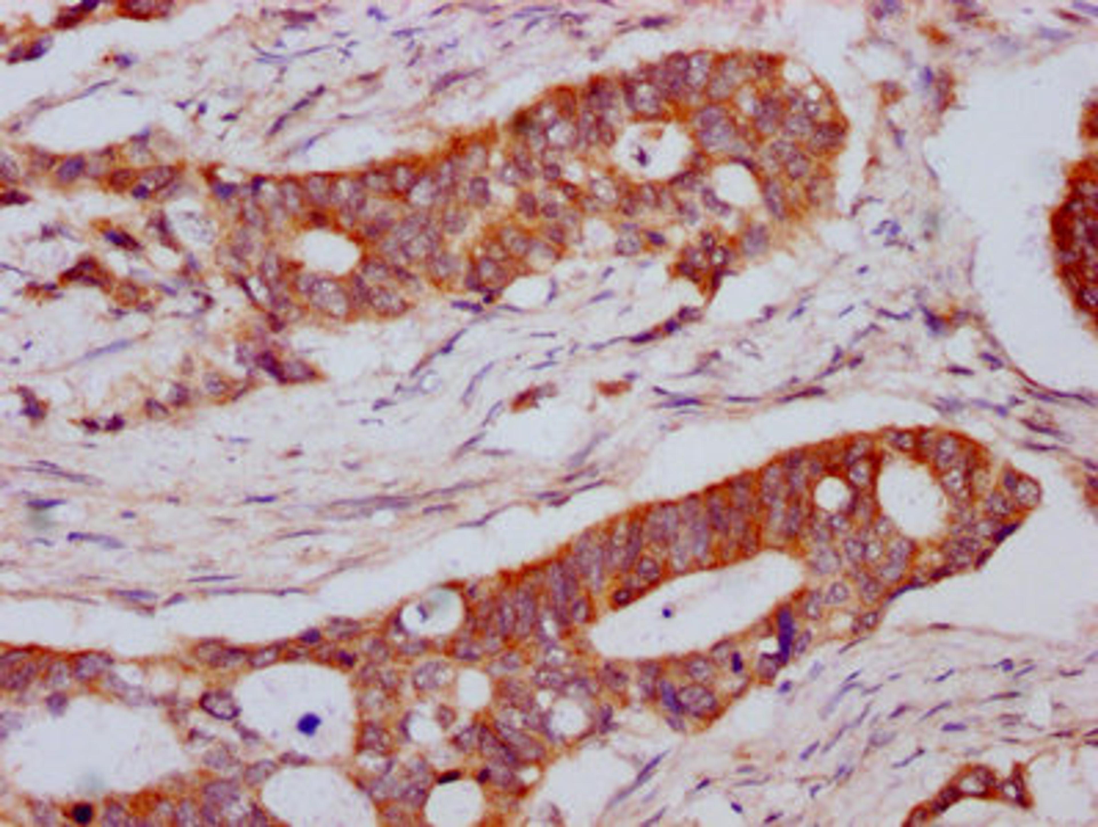 IHC image of CSB-PA013065LA01HU diluted at 1:800 and staining in paraffin-embedded human colon cancer performed on a Leica BondTM system. After dewaxing and hydration, antigen retrieval was mediated by high pressure in a citrate buffer (pH 6.0). Section was blocked with 10% normal goat serum 30min at RT. Then primary antibody (1% BSA) was incubated at 4°C overnight. The primary is detected by a biotinylated secondary antibody and visualized using an HRP conjugated SP system.