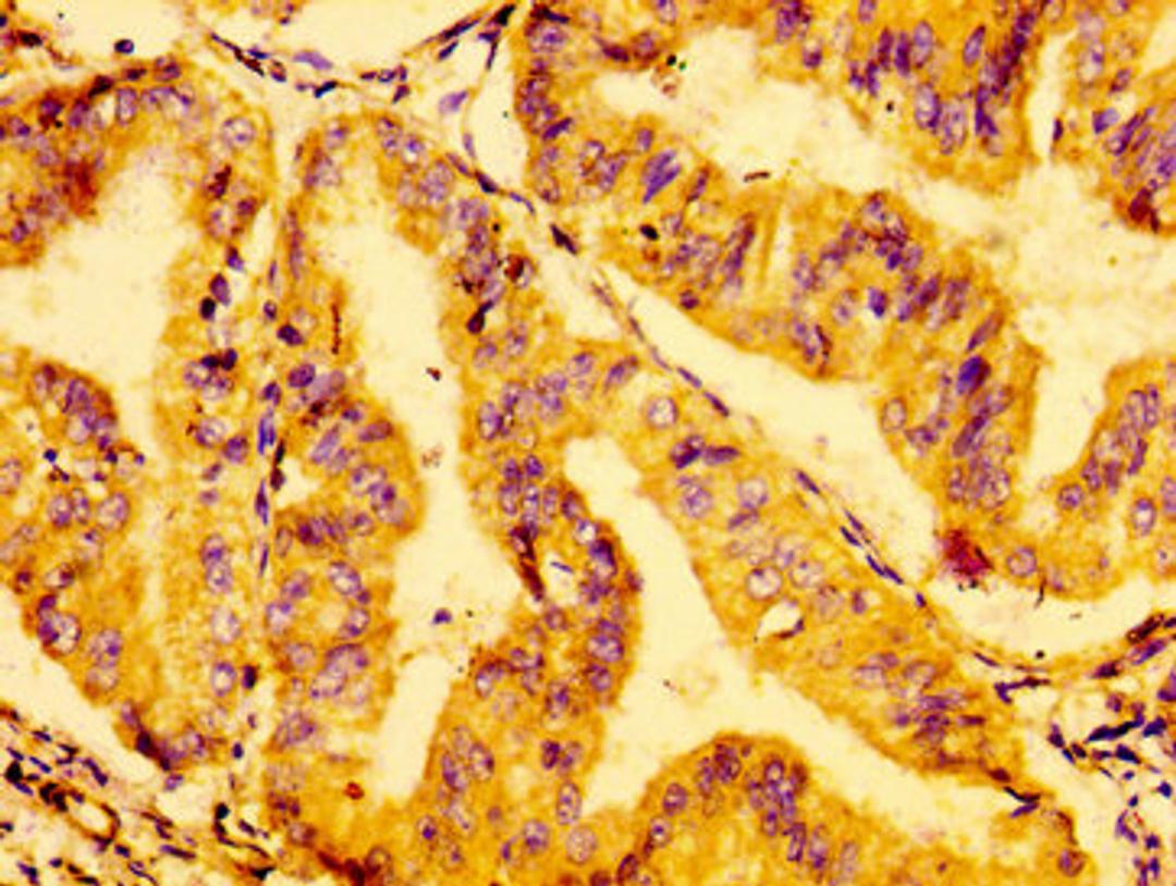 IHC image of CSB-PA009888LA01HU diluted at 1:100 and staining in paraffin-embedded human cervical cancer performed on a Leica BondTM system. After dewaxing and hydration, antigen retrieval was mediated by high pressure in a citrate buffer (pH 6.0). Section was blocked with 10% normal goat serum 30min at RT. Then primary antibody (1% BSA) was incubated at 4&deg;C overnight. The primary is detected by a biotinylated secondary antibody and visualized using an HRP conjugated SP system.