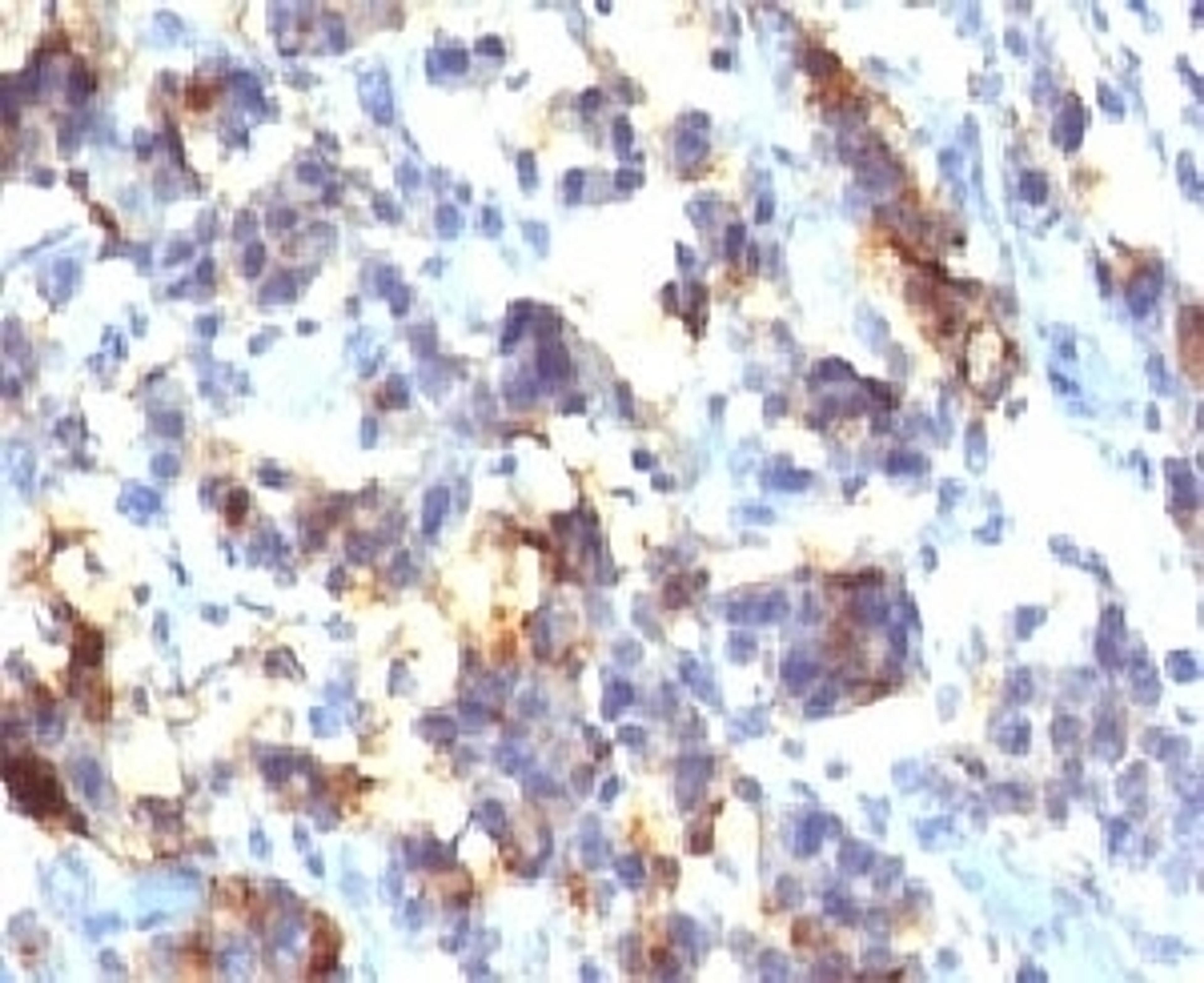 IHC testing of FFPE human gastric carcinoma with MUC5AC antibody (clone MUCN5AC).