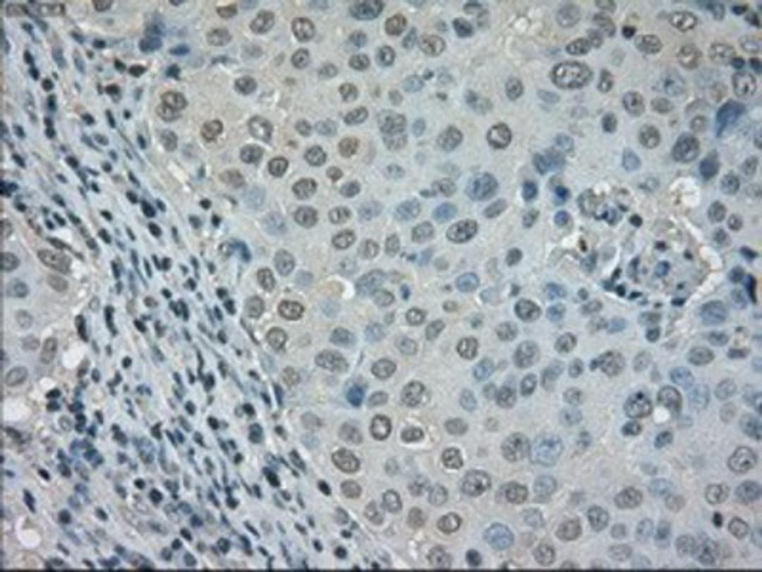 Immunohistochemistry-Paraffin: Dihydrofolate reductase Antibody (6G7) [NBP1-47727] - Staining of paraffin-embedded Adenocarcinoma of breast tissue using anti-Dihydrofolate reductase mouse monoclonal antibody.