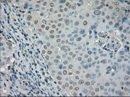 Immunohistochemistry-Paraffin: Dihydrofolate reductase Antibody (6G7) [NBP1-47727] - Staining of paraffin-embedded Adenocarcinoma of breast tissue using anti-Dihydrofolate reductase mouse monoclonal antibody.