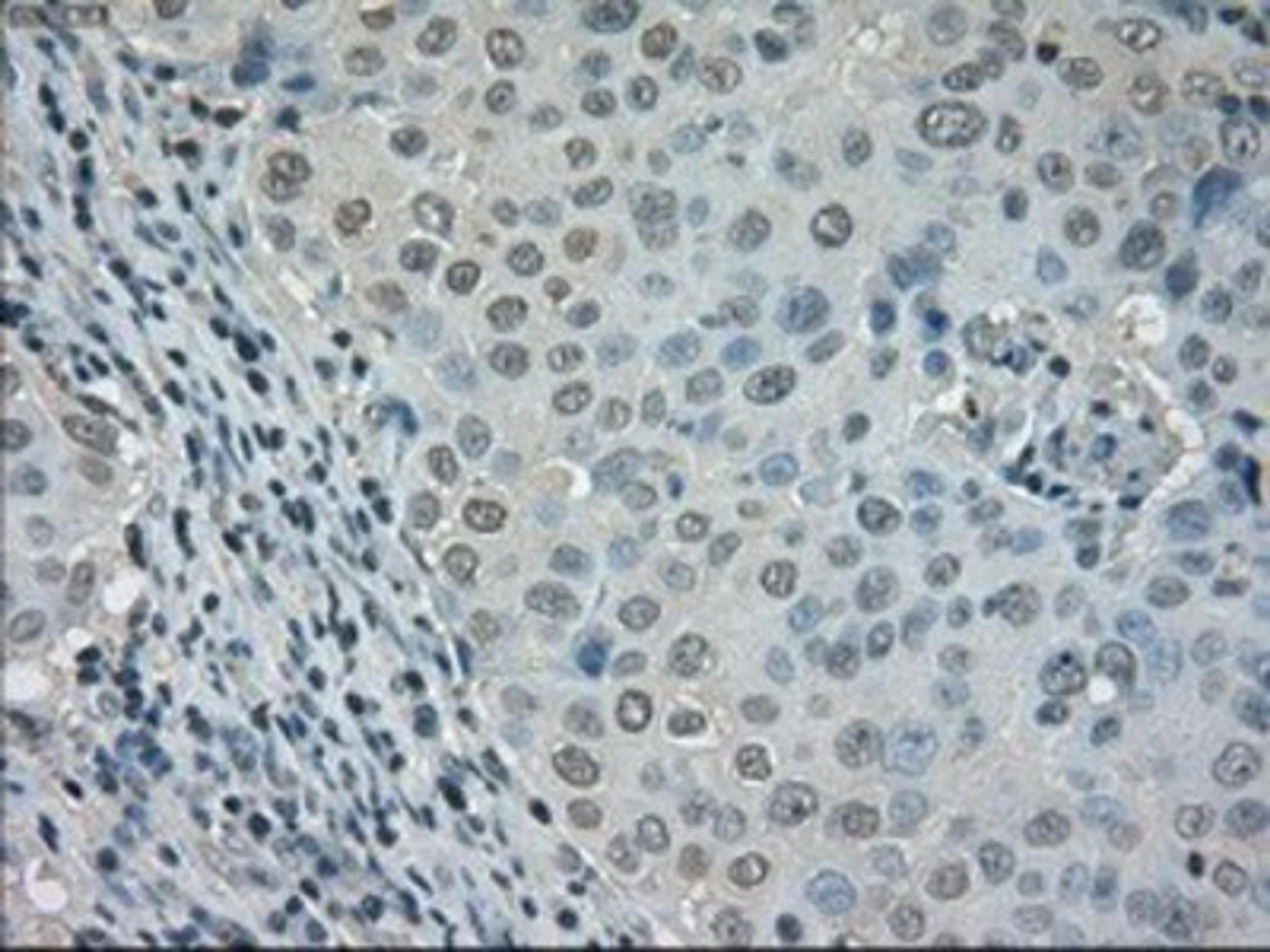 Immunohistochemistry-Paraffin: Dihydrofolate reductase Antibody (6G7) [NBP1-47727] - Staining of paraffin-embedded Adenocarcinoma of breast tissue using anti-Dihydrofolate reductase mouse monoclonal antibody.